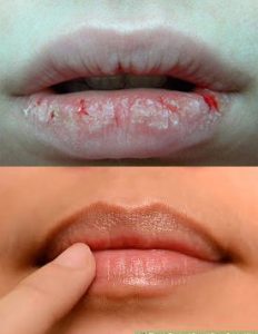 cracked-lips