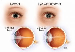 ayurvedic treatment for cataracts