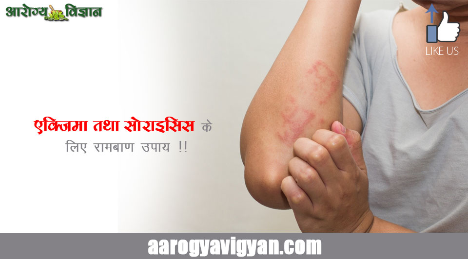 eczema-ayurvedic-treatment-home-remedy