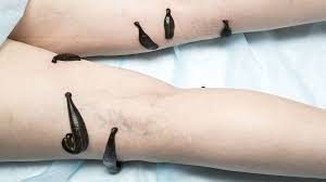 Leech Therapy for Joints Pain in punjab